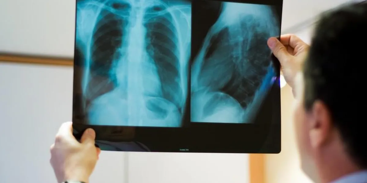 radiologue et radio des poumons