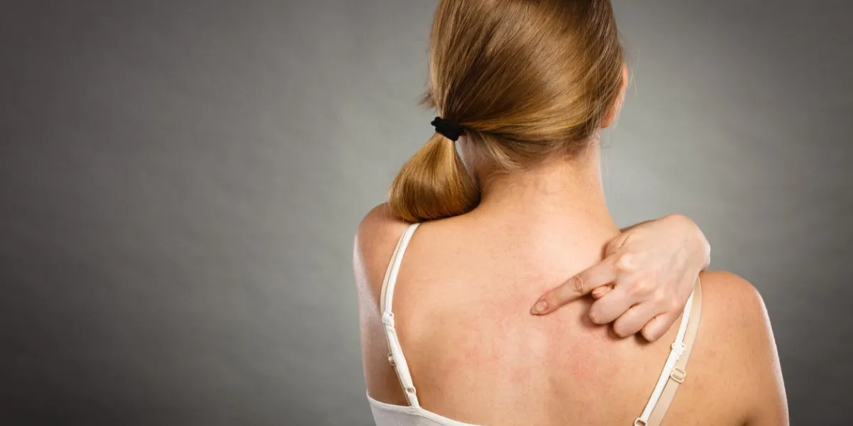 problème de santé, les maladies de la peau jeune femme montrant ses démangeaisons de retour avec des symptômes d'urticaire éruption allergique