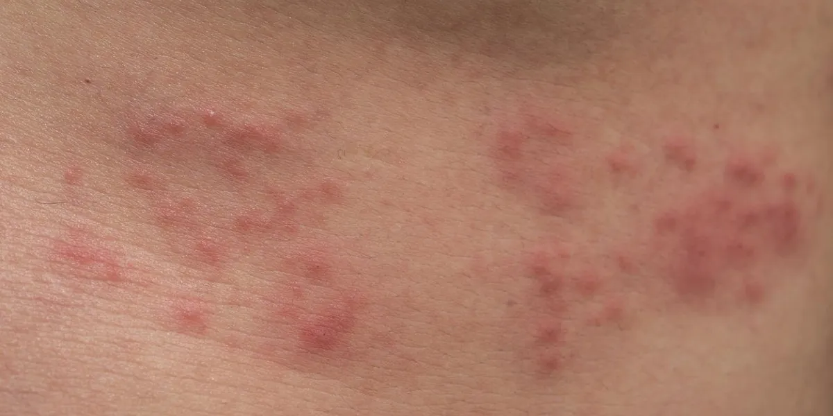 gros plan de la peau du corps avec le zona (bardeaux)