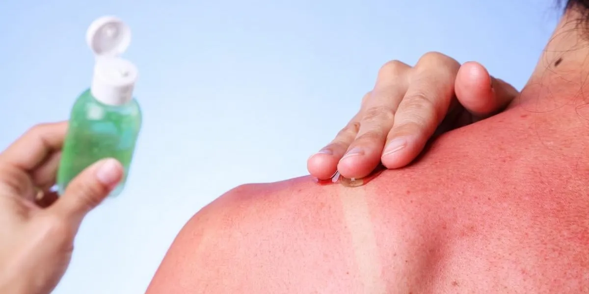 woman rubbing aloe vera gel on her sunburned shoulder