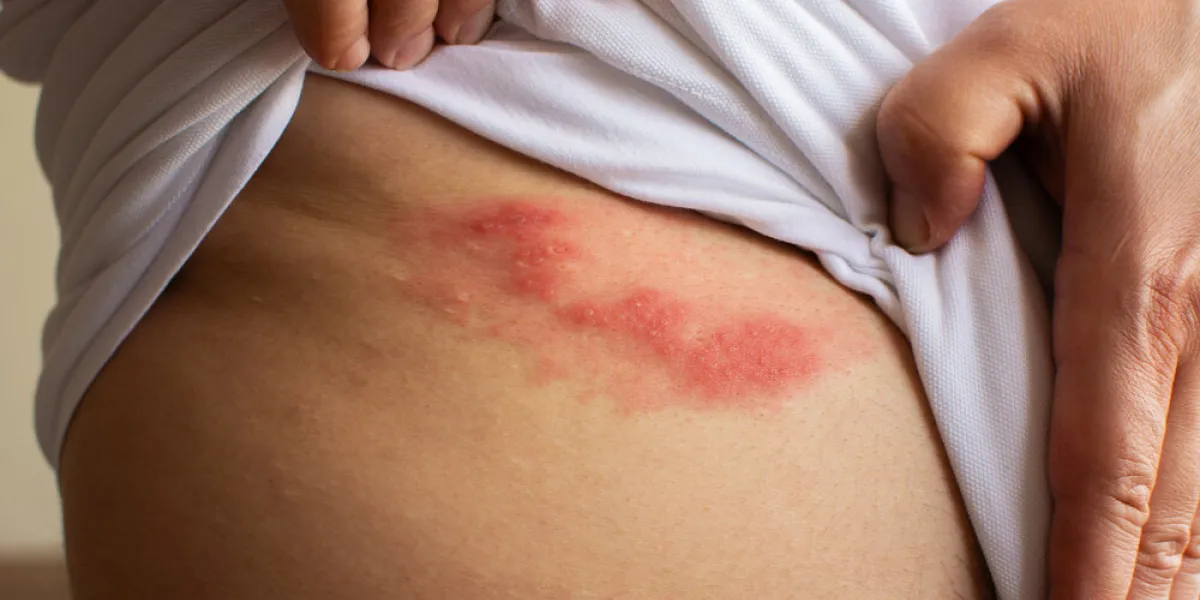 shingles (herpes zoster) blister skin rash
