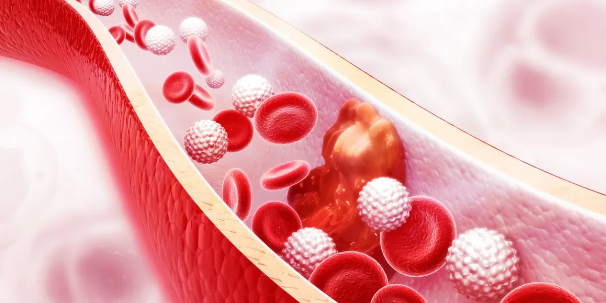 cholesterol plaque in artery on science background