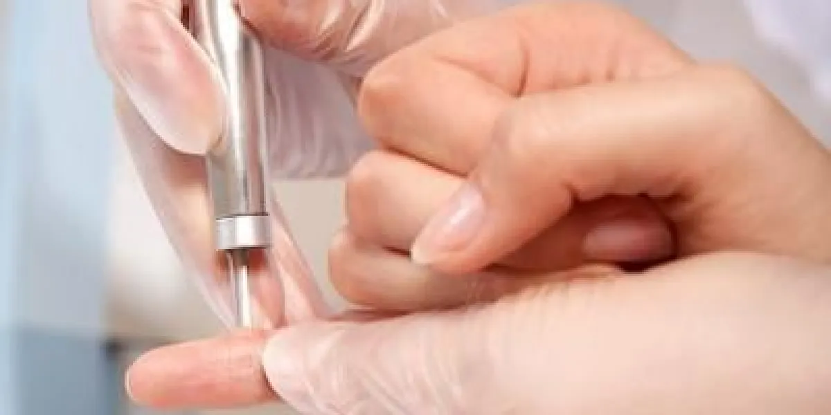 retrait au laser de la verrue à l'hôpital