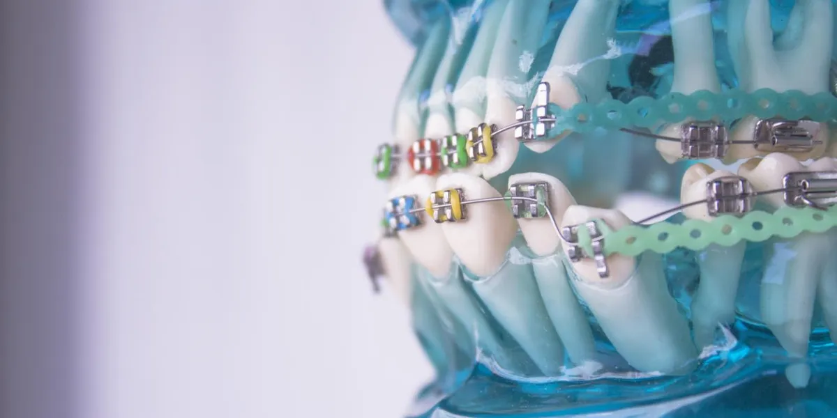 denture for students with classic dental metal orthodontics color aesthetic couplings