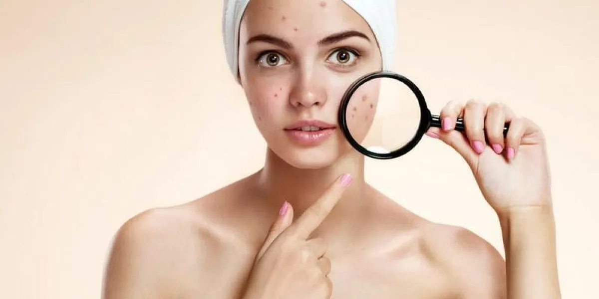 photos de fille laide problème de peau sur fond beige