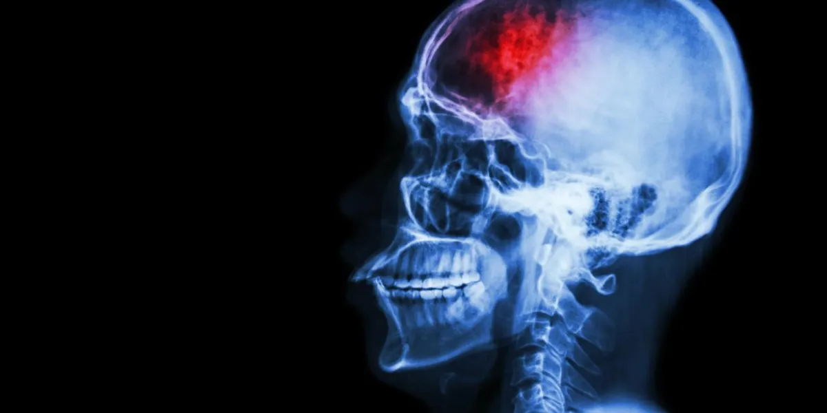 stroke (cerebrovascular accident) film x-ray skull lateral with stroke and blank area at left side