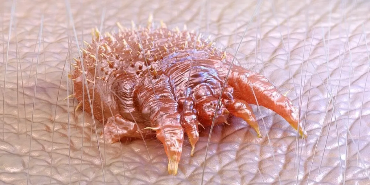 sarcoptes,scabiei,,microscopic,mite,,causes,scabies,infestation,affects,skin,,leading