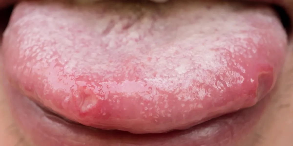 tongue with ulcers of adult man