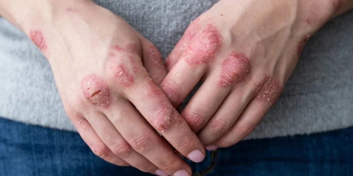 cracked, flaky skin on the hands dermatological problems of psoriasis hard, horny and cracked skin on the finger in a woman's hands hand stains, dry skin psoriasis, allergy