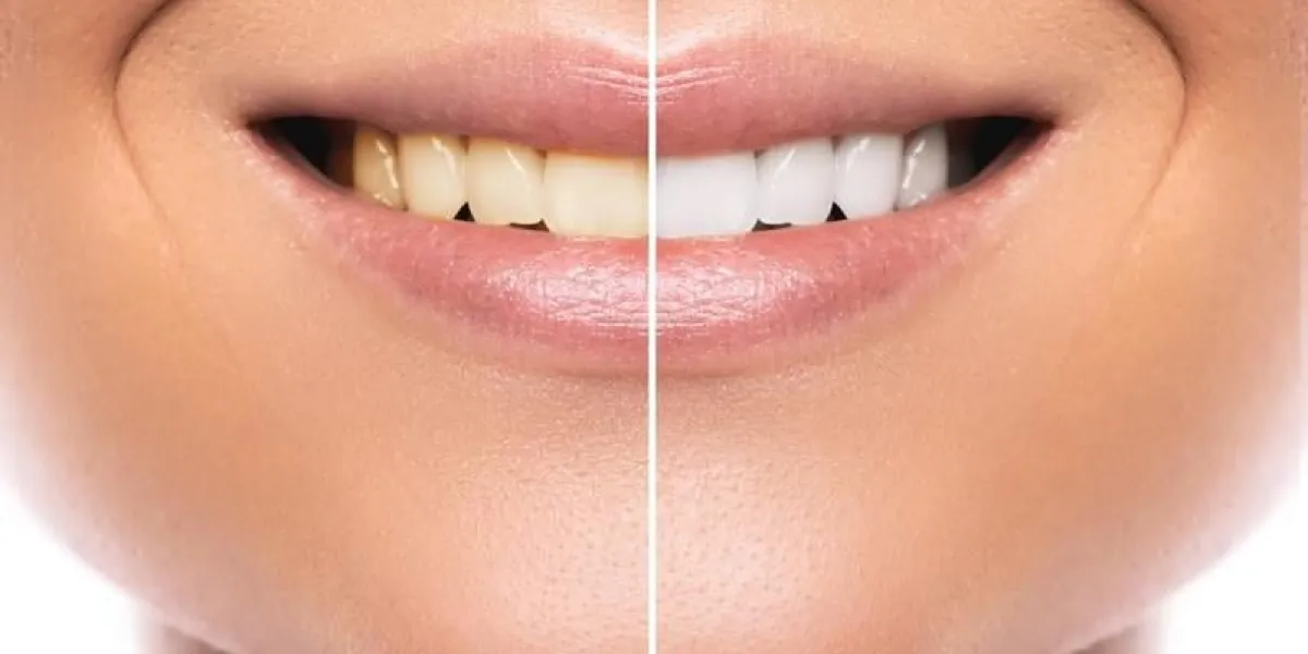 gros plan de la comparaison de la bouche féminine après le blanchiment des dents