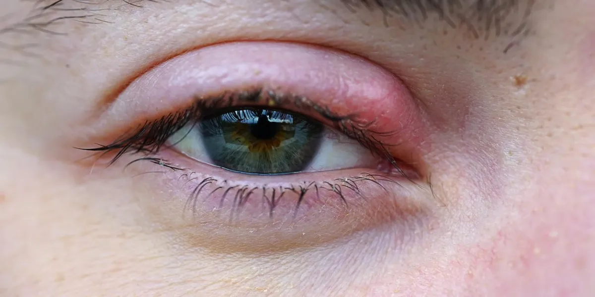 eye stye macro