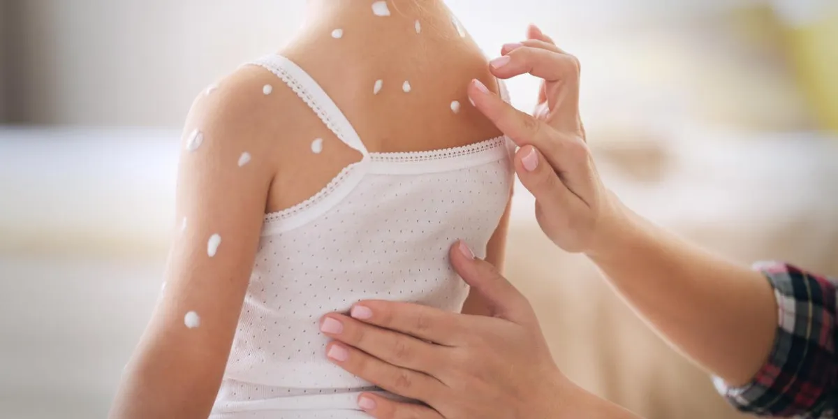 female hands applying cream on little girl with chicken pox at home