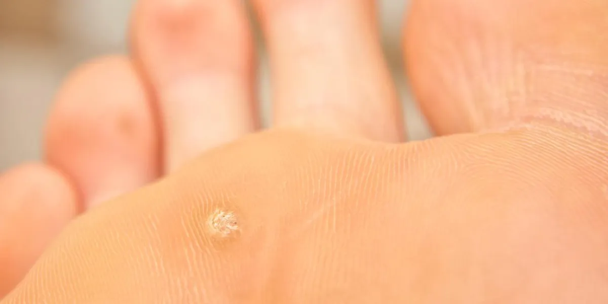 callus and hyperkeratosis under a human foot, close-up, dried skin