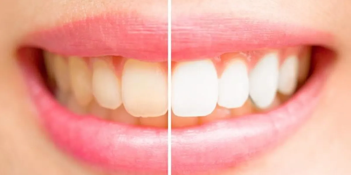 dents rapprochées femelle entre avant et après se brosser les dents