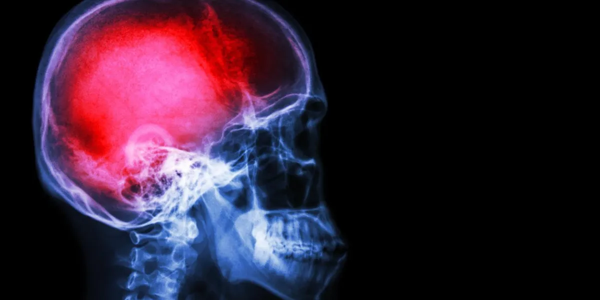 crâne radiologique et rachis cervical (latéral) avec avc