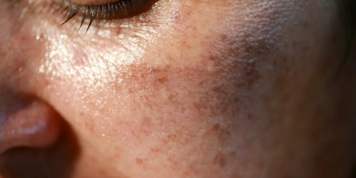 pigmented spots on the face pigmentation on cheeks