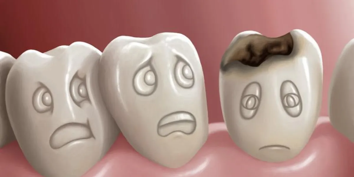 caries dentaires