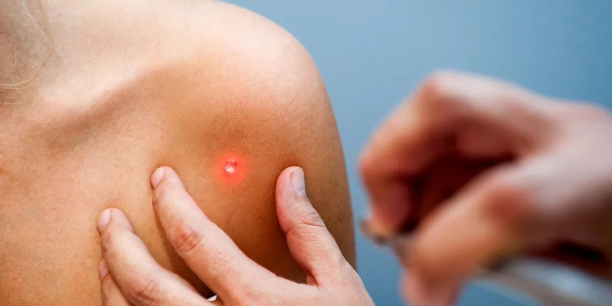 une consultation médicale à l'enlèvement de naevus