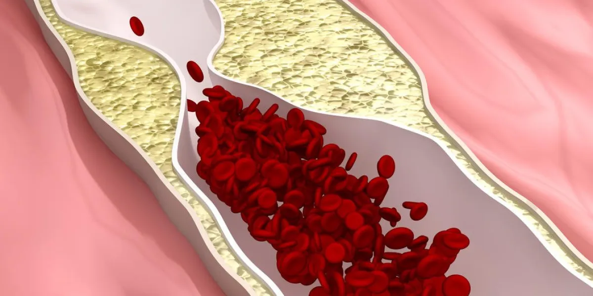 atherosclerosis disease - clogged arteries (arterial plaque)