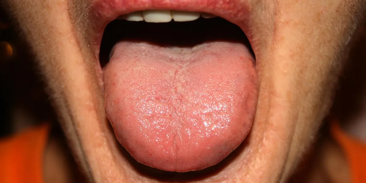 candidiasis in the tongue white coating thrush