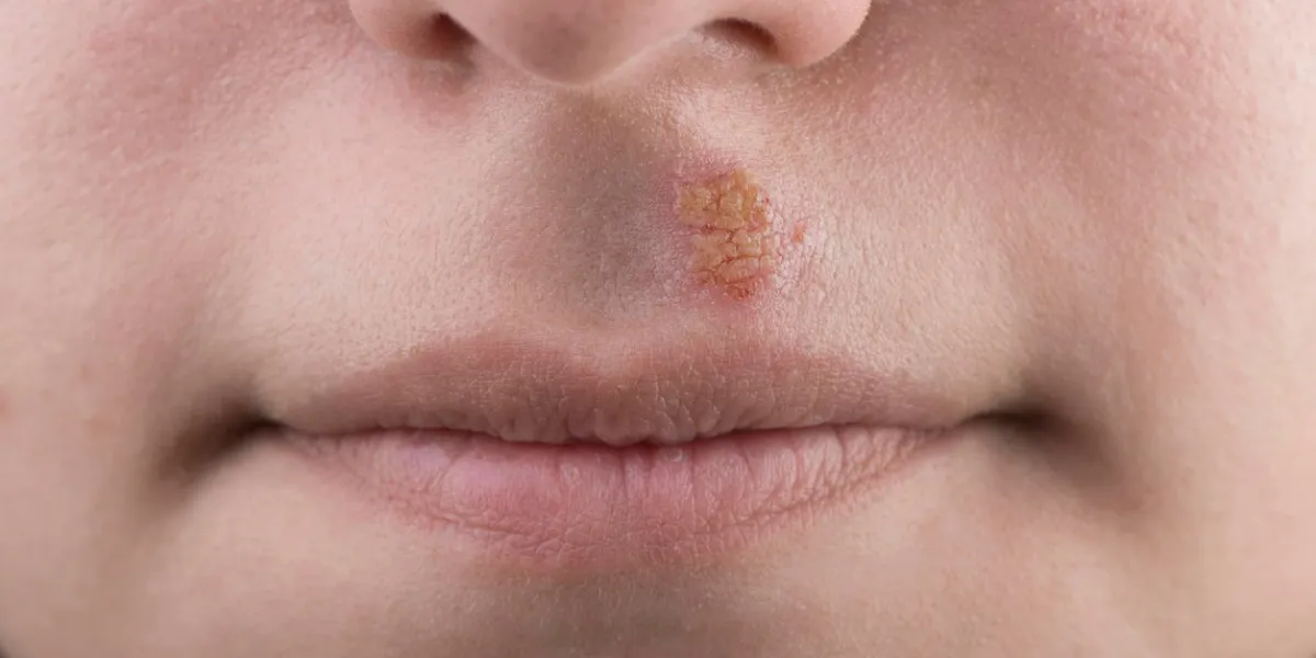 gros plan d'un herpès simplex virus herpès simplex commun