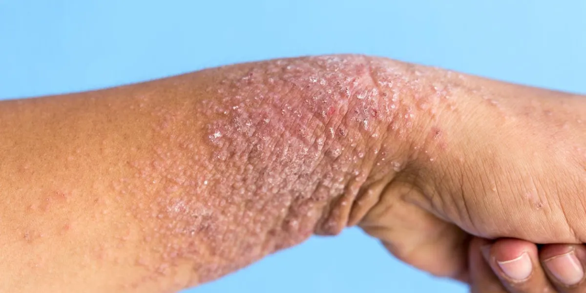 hand dermatitis, eczema on hand
