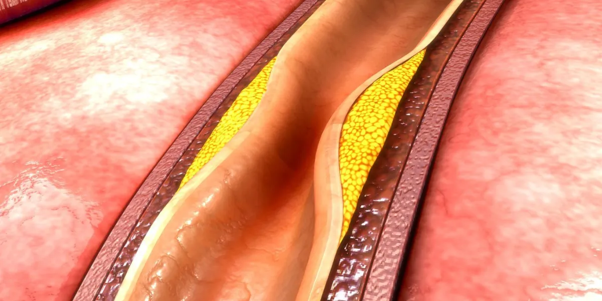 les artères, qui commencent doucement et élastiquement, obtiennent une plaque sur leurs parois internes, ce qui peut les rendre plus rigides et rétrécies, ce qui restreint le flux sanguin vers votre cœur, qui peut alors devenir privé d'oxygène