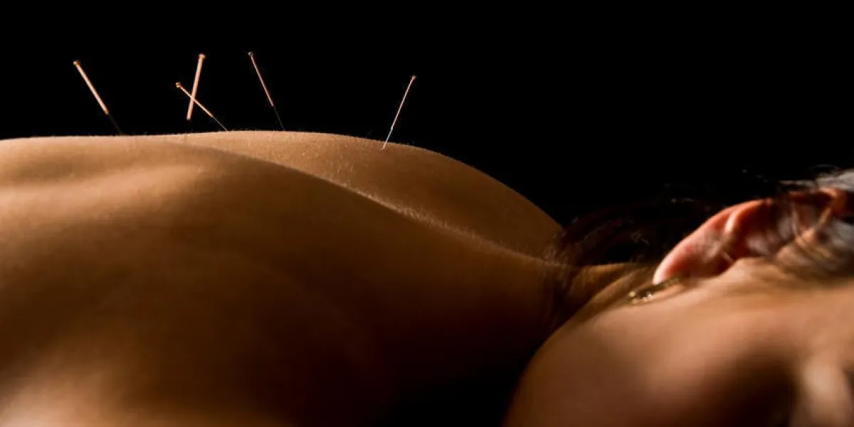 femme recevant un traitement d'acupuncture dans un spa