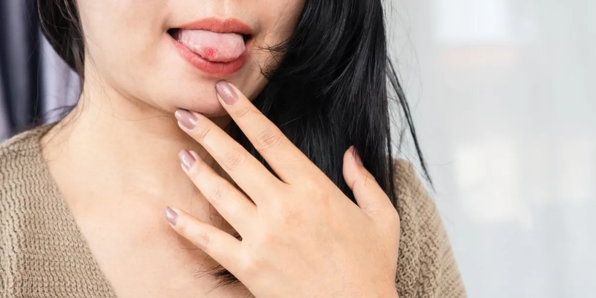 closeup asian woman have sore in the mouth, tongue, aphthous ulcer