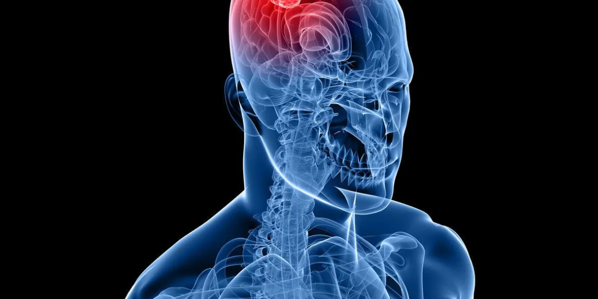 illustration de cancer du cerveau