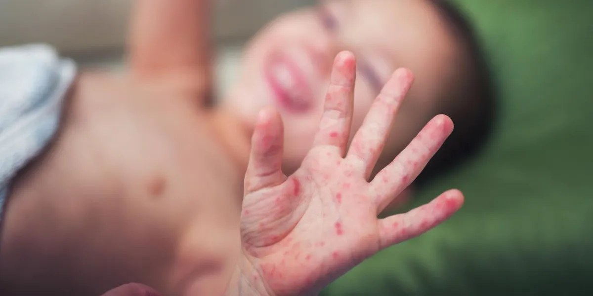 boy with symptoms hand, foot and mouth disease