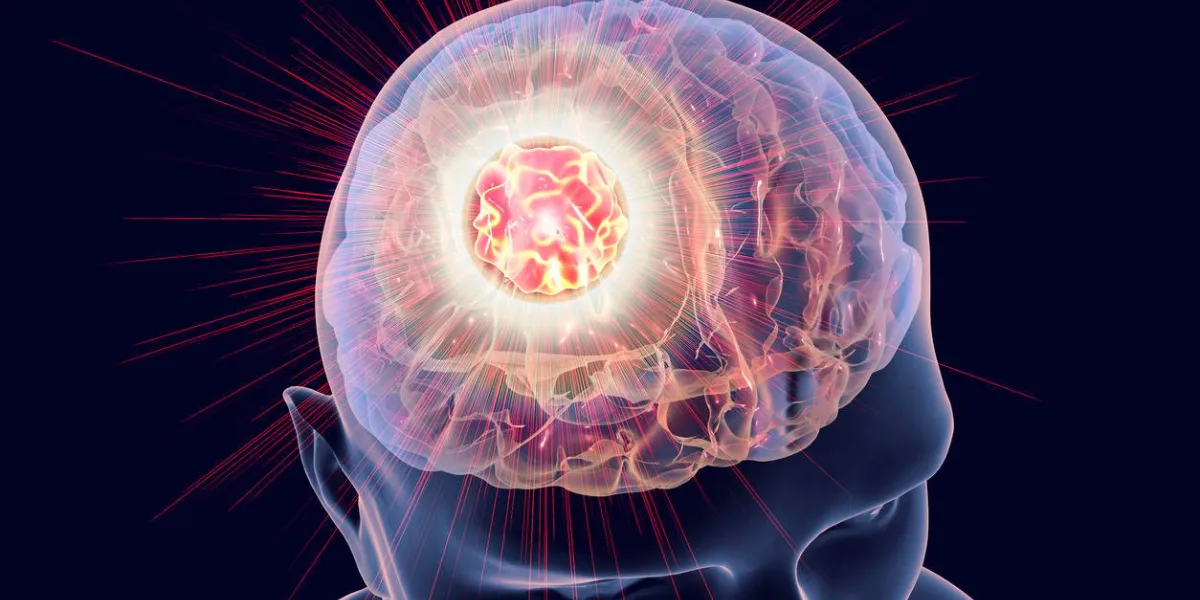 destruction de la tumeur cérébrale, image conceptuelle illustration 3d pour le traitement du cancer du cerveau