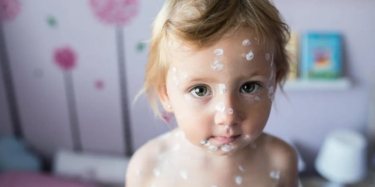 petite fille de deux ans à la maison malade de la varicelle, crème antiseptique blanche appliquée à l'éruption