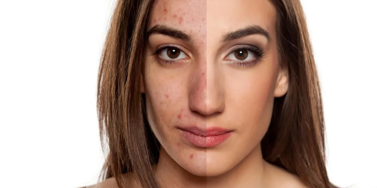 portrait de comparaison d'une femme avec la peau problématique sans et avec le maquillage