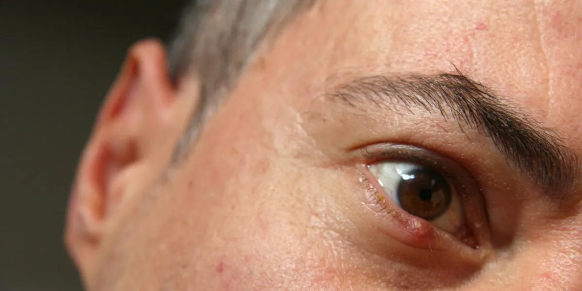 stye, eye infection in a middle-aged man