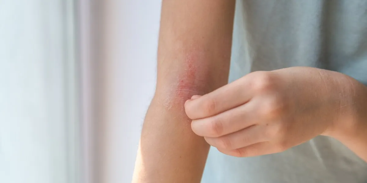 a girl scratches the skin on the elbow of her arm, redness is atopic dermatitis, the girl s face is not visible
