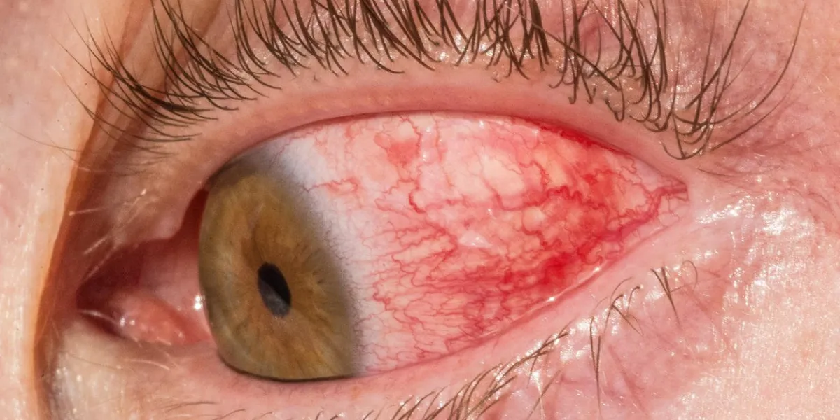 inflamed red eye from a man due to allergy