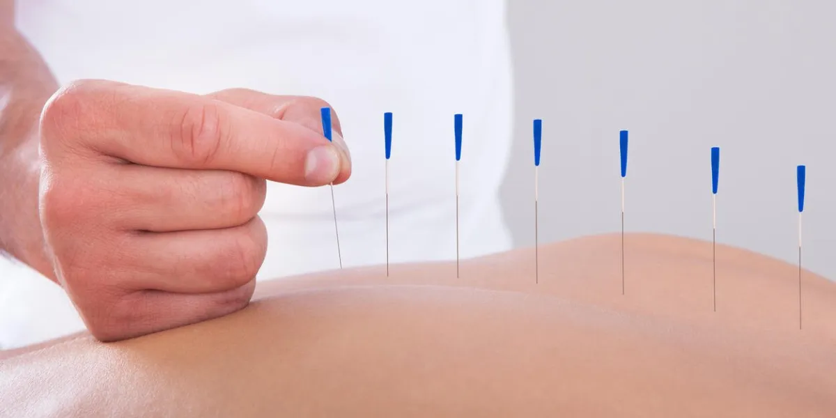 jeune femme belle dans une thérapie d'acupuncture dans un centre de spa