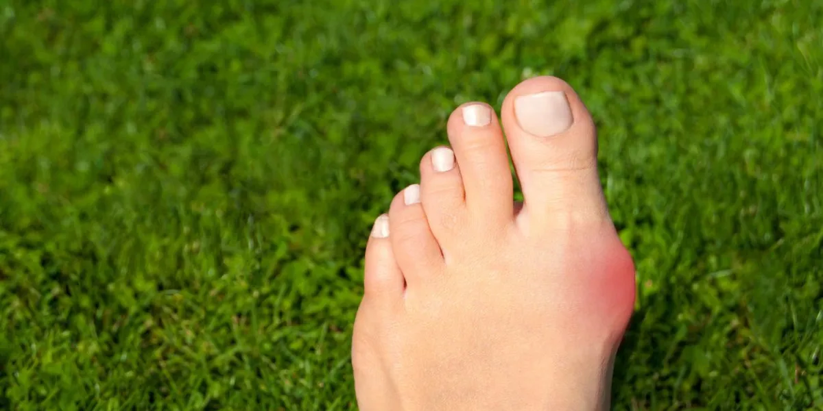 hallux valgus, bunion in woman foot on grass background