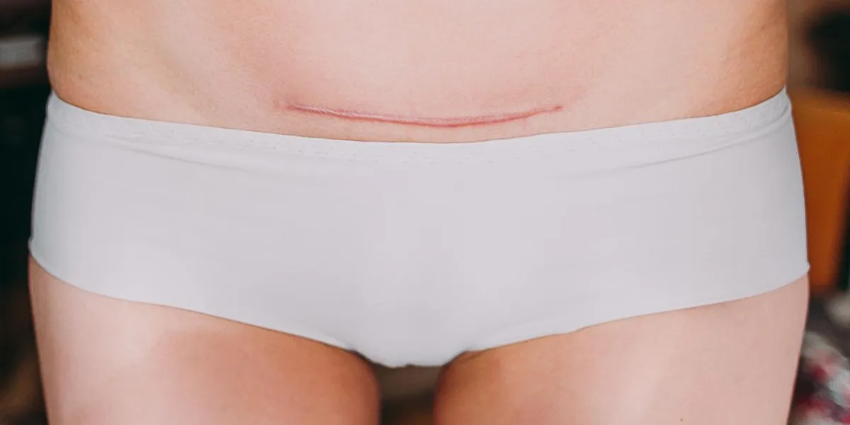 closeup of woman belly with a scar from a cesarean section