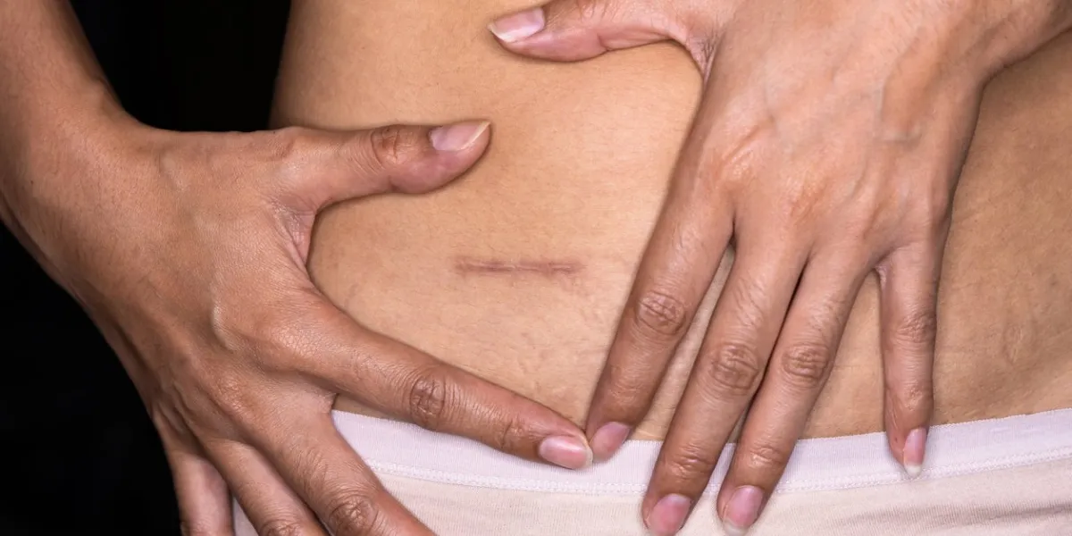 woman showing on your stomach with a appendicitis scar, appendicitis scar on the woman stomach