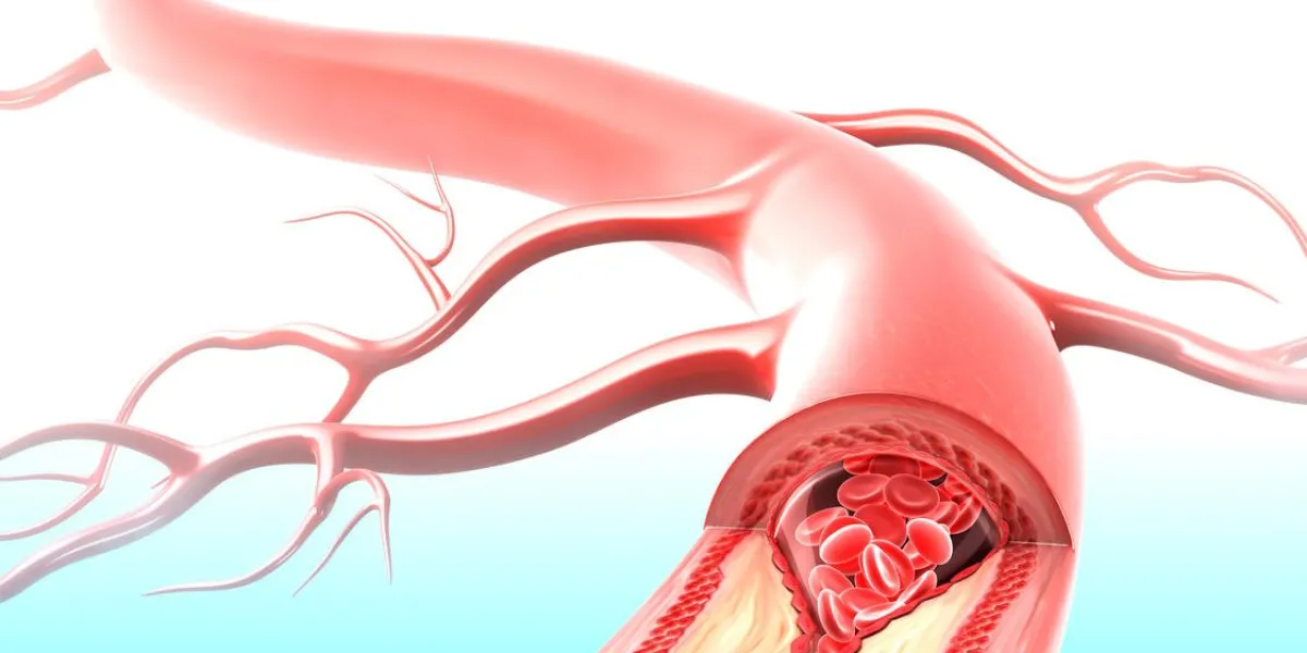 athersclerosis in artery