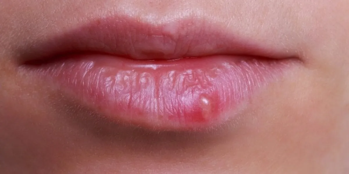 herpes on the lips of a young girl