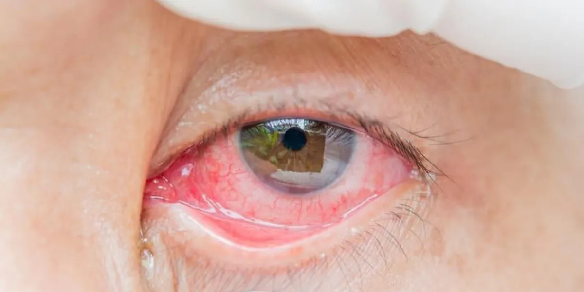 œil rouge injecté de sang