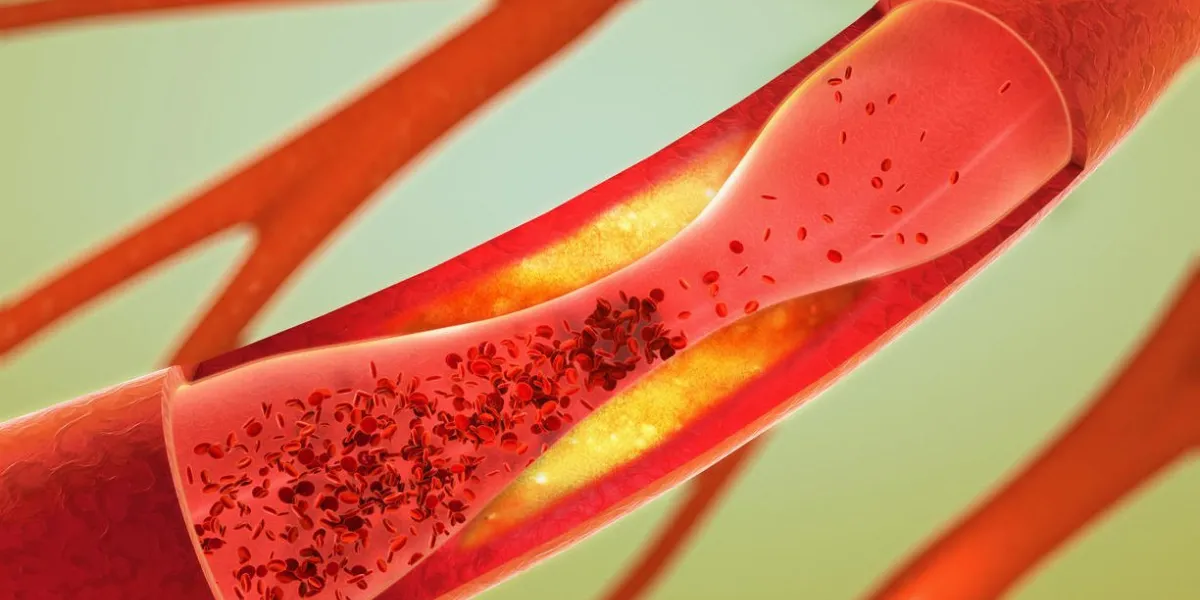 précipité et rétrécissement des vaisseaux sanguins - artériosclérose