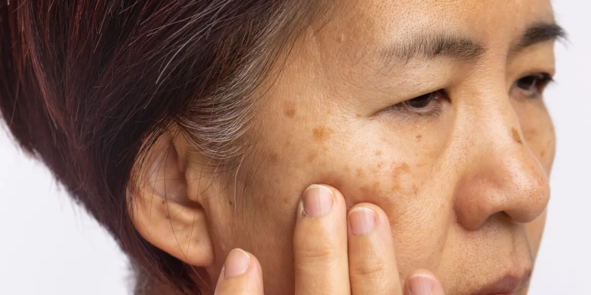 menopausal women worry about melasma on face