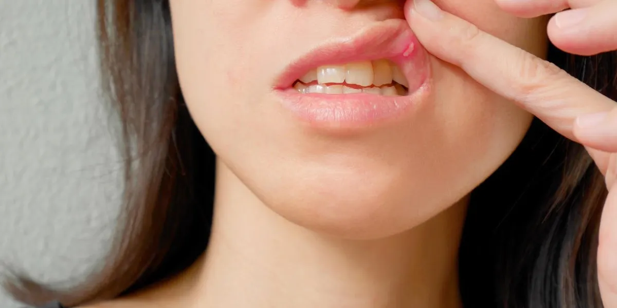 chancre endolori sur la lèvre supérieure de la femme