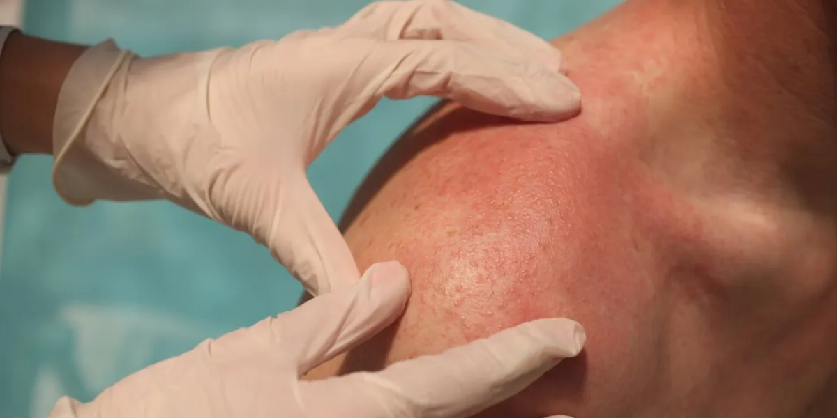 doctor dermatologist examining rash on skin of man shoulders using gloves closeup differential diagnosis of allergic and infectious skin diseases concept
