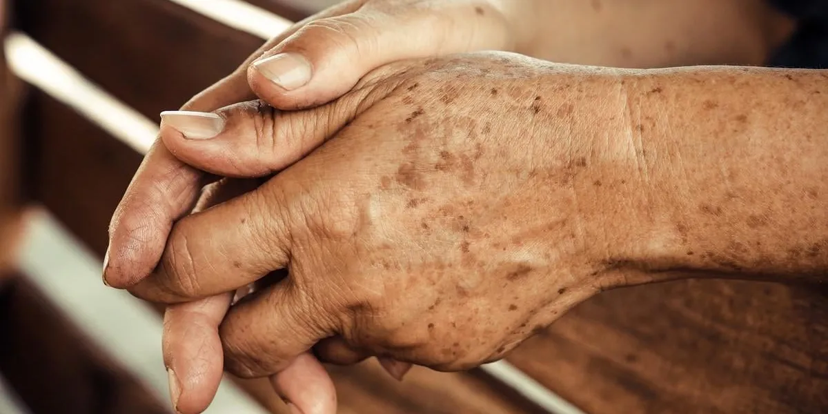 hands of a female elderly full of freckles