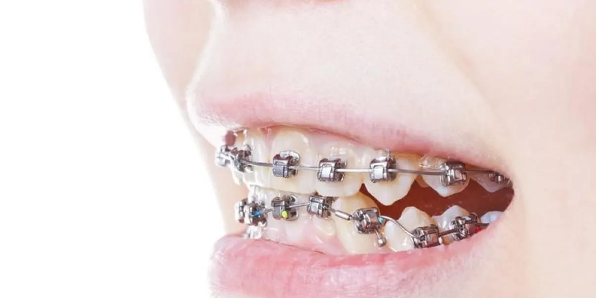 les brackets dentaires en acier sur les dents se bouchent pendant le traitement orthodontique